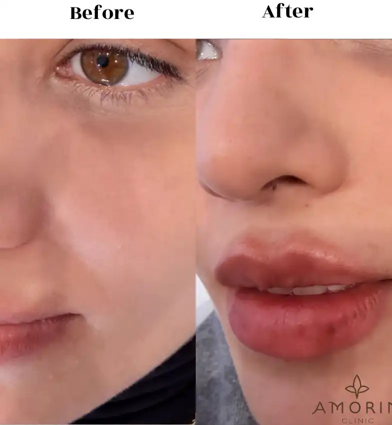before after 4